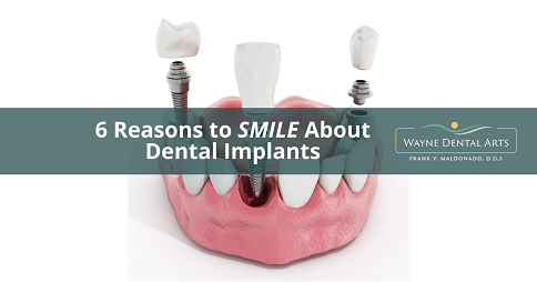 6 Reasons to Smile About Dental Implants